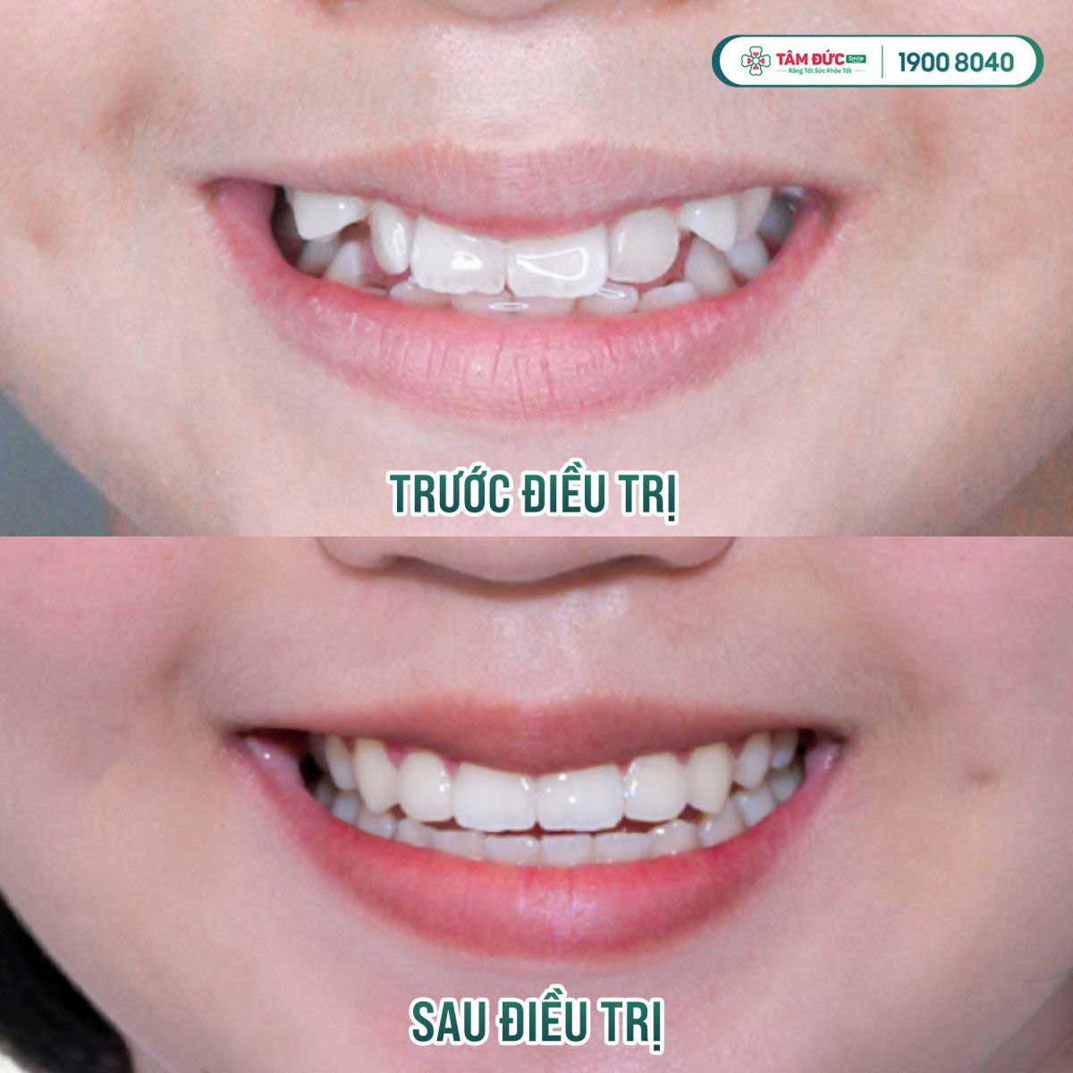 Hình ảnh trước và sau khi tháo niềng tại nha khoa Tâm Đức Smile