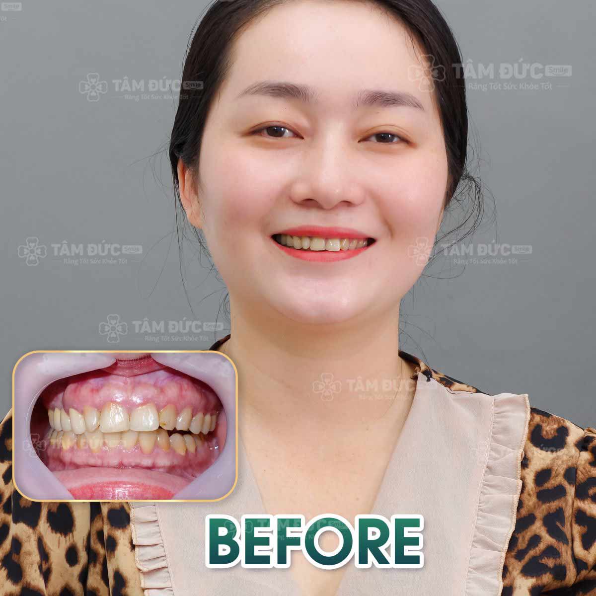 khách hàng sau khi làm răng sứ tại nha khoa tâm đức smile