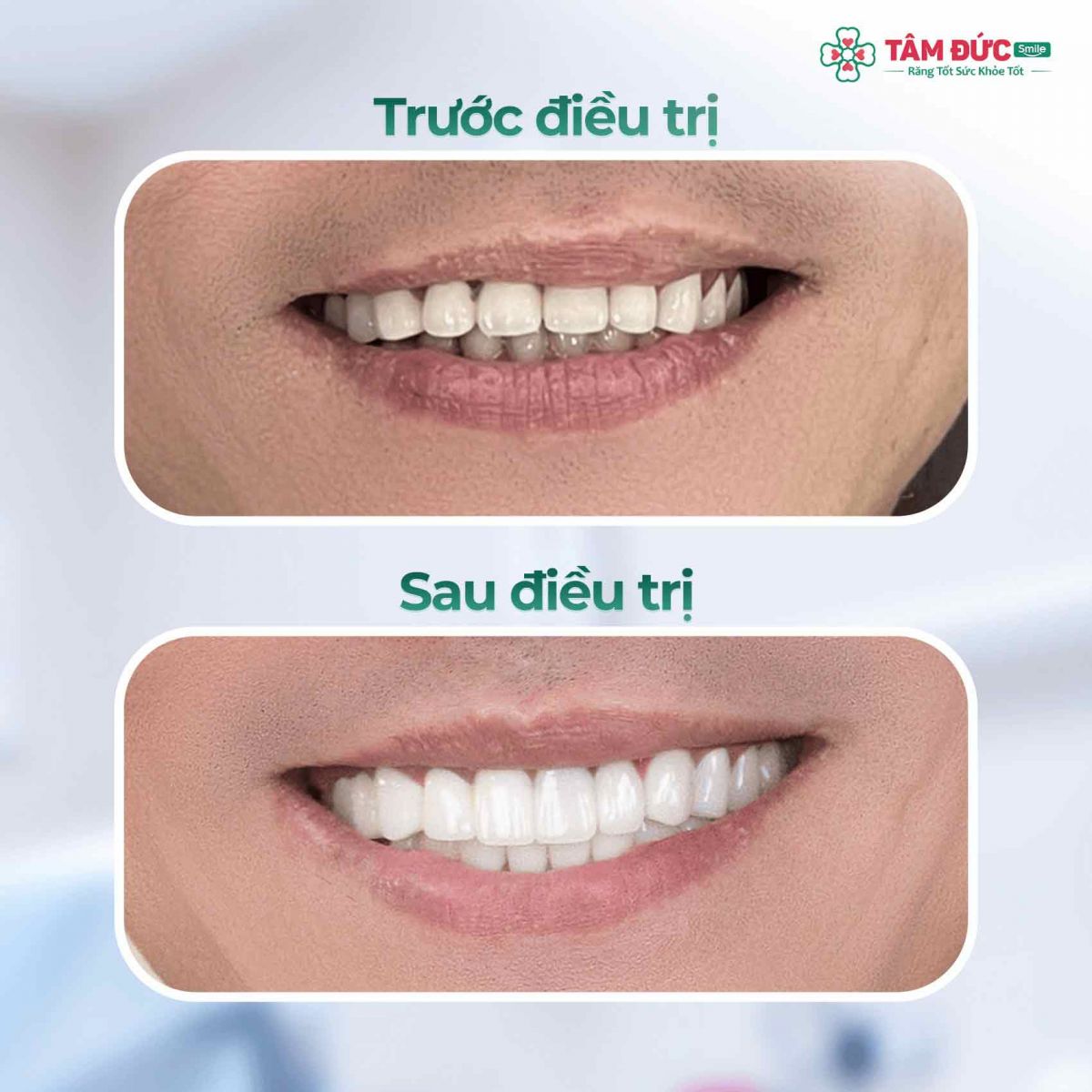 form răng sứ đẹp tại nha khoa Tâm Đức Smile