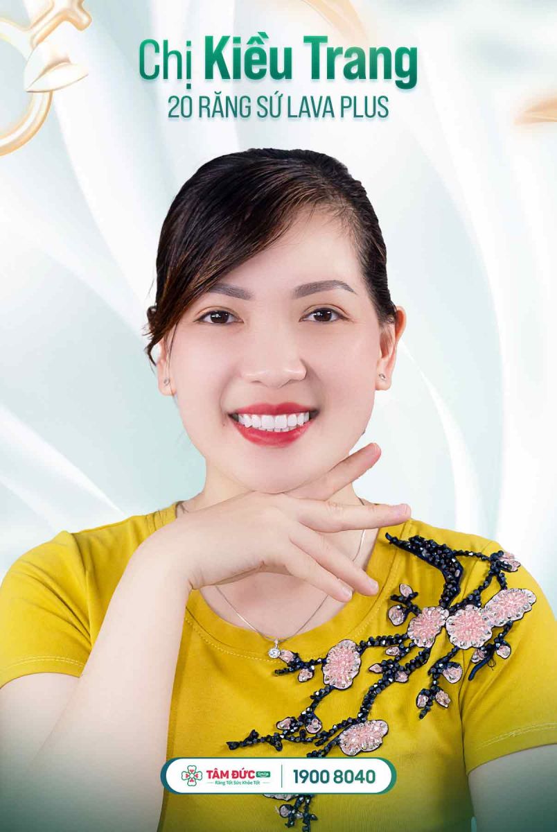 chị kiều trang sau khi bọc răng sứ tại nha khoa Tâm Đức Smile