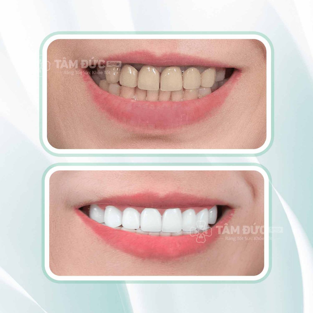 form răng sứ đẹp tại nha khoa Tâm Đức Smile