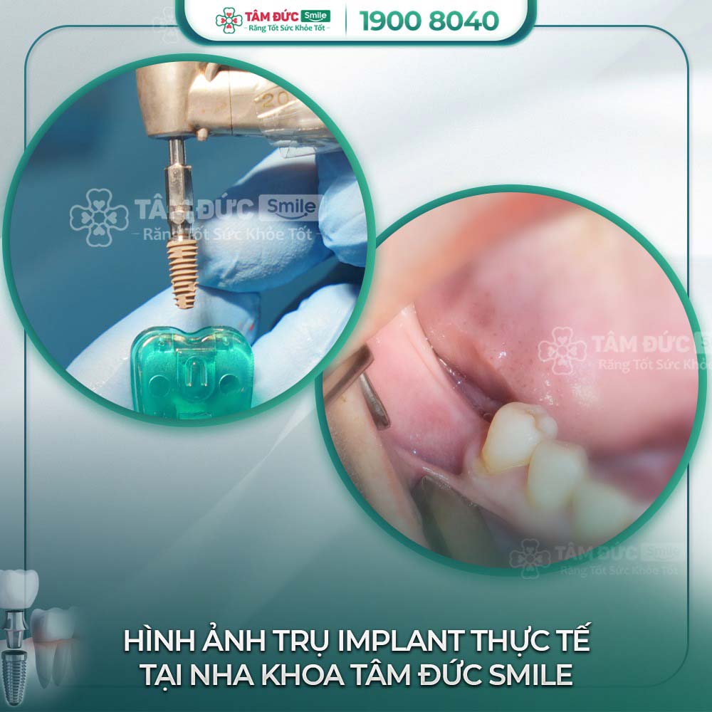 Trồng răng implant khi gãy răng hàm, chân răng lung lay