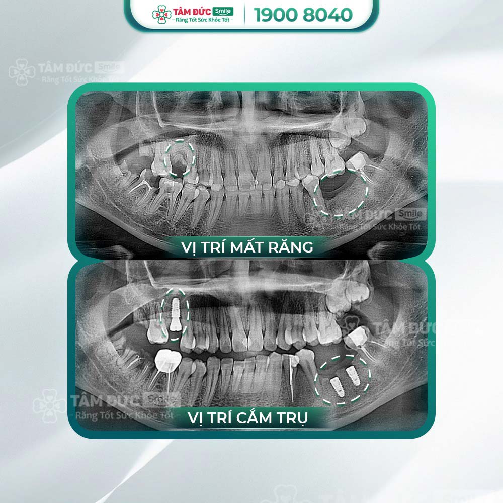 Trồng răng implant khi gãy răng hàm, chân răng lung lay