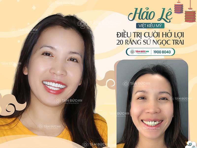 bọc răng sứ tại nha khoa Tâm Đức Smile