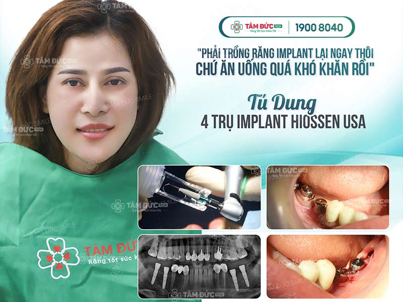 chị Dung cấy ghép Implant tại nha khoa Tâm Đức Smile