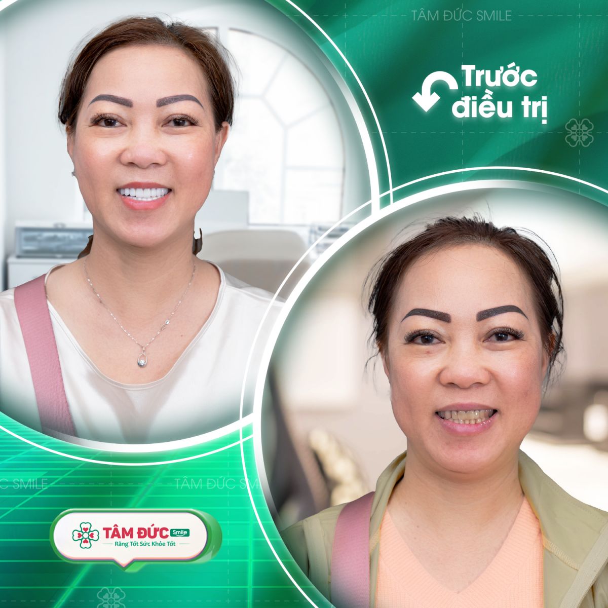 giá bọc răng sứ tại nha khoa Tâm Đức Smile