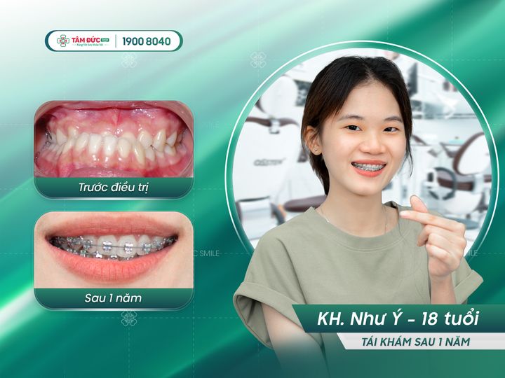 chi phí niềng răng mắc cài kim loại