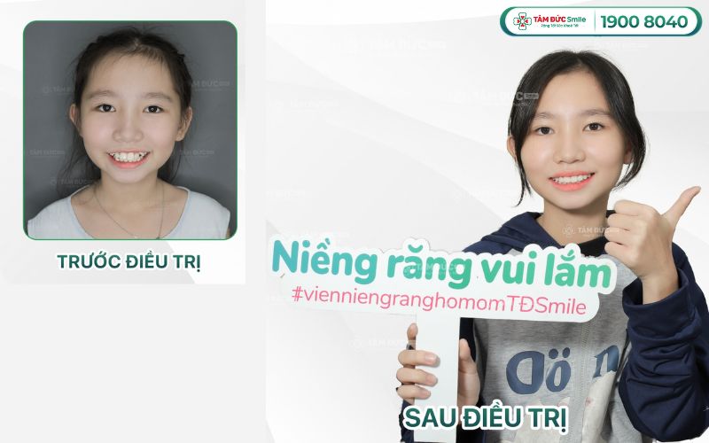 gia-nieng-rang-cho-tre-10-tuoi-2