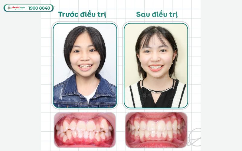gia-nieng-rang-cho-tre-10-tuoi-3