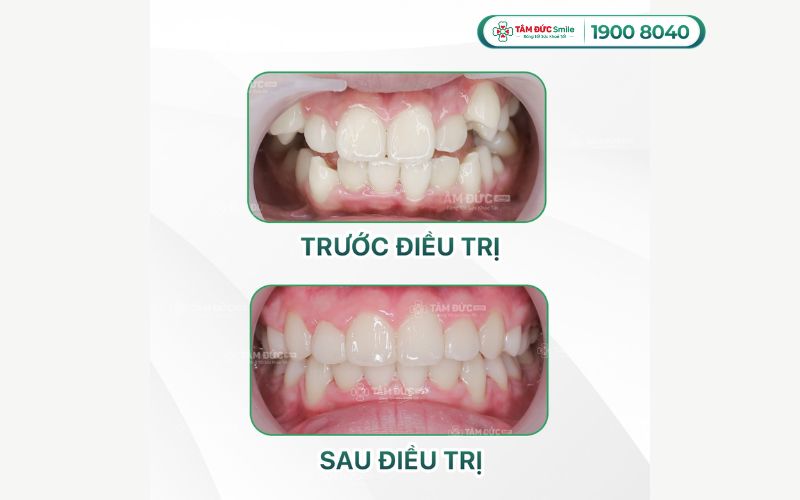 gia-nieng-rang-cho-tre-10-tuoi-6