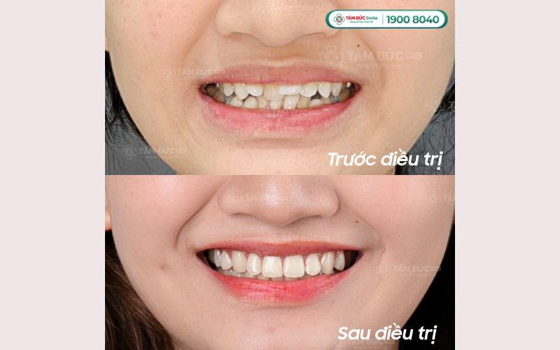 gia-nieng-rang-cho-tre-10-tuoi-7