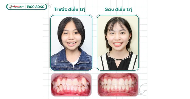 Giá niềng răng cho trẻ 10 tuổi bao nhiêu? Ưu đãi tại Nha khoa Tâm Đức Smile