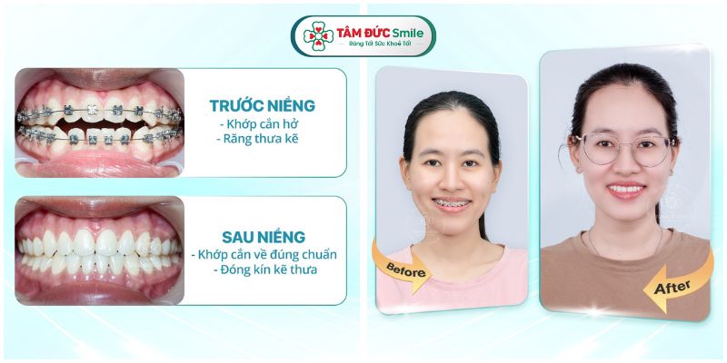 gia-nieng-rang-da-nang-2