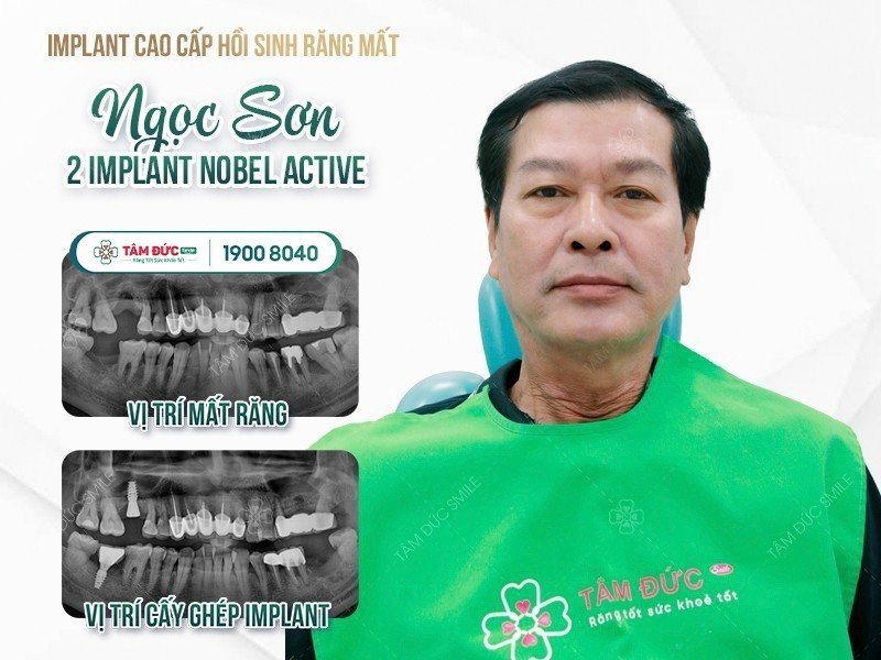 giá trồng răng cửa bị mất tại nha khoa Tâm Đức Smile