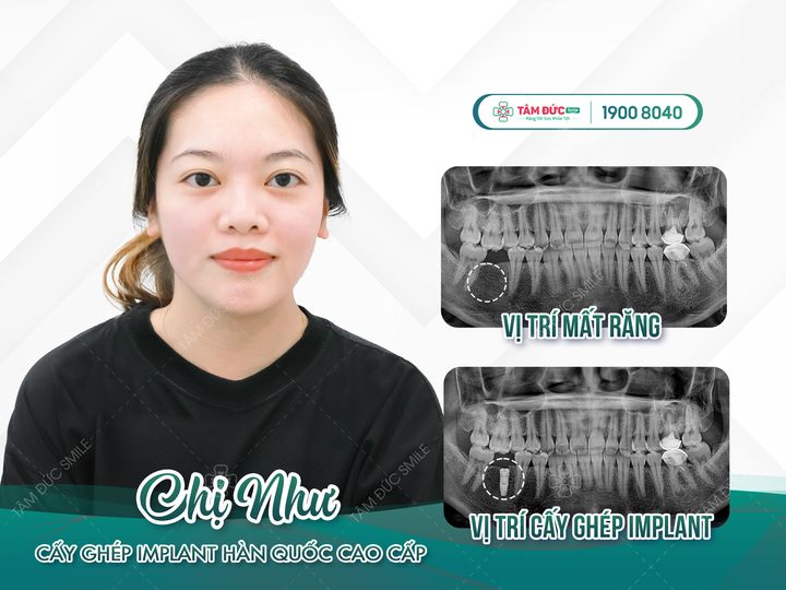 giá trồng răng hàm dưới bao nhiêu tiền