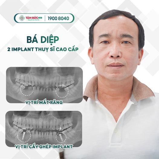 giá trồng răng hàm dưới tại nha khoa Tâm Đức Smile