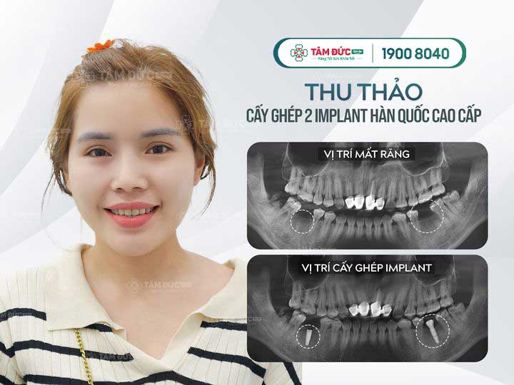 chị thu thảo trồng răng hàm dưới tại nha khoa tâm đức smile