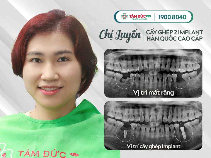 Chị Luyến trồng răng hàm dưới tại nha khoa Tâm Đức Smile