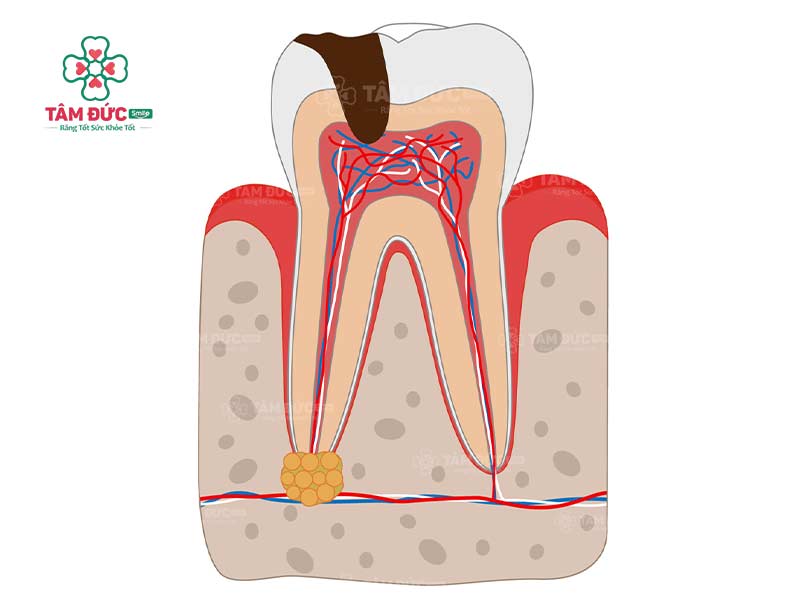 áp xe răng có tự khỏi không