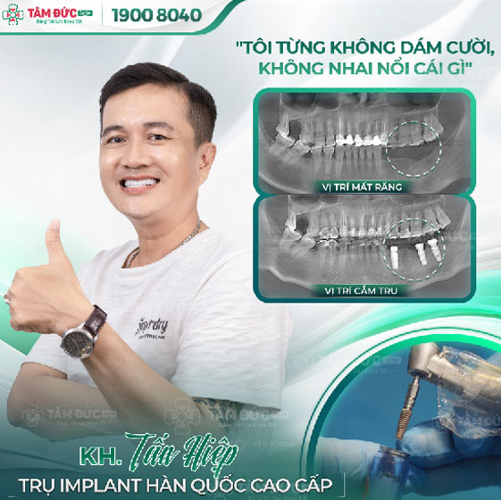 khách hàng trồng răng Implant tại nha khoa tâm đức smile