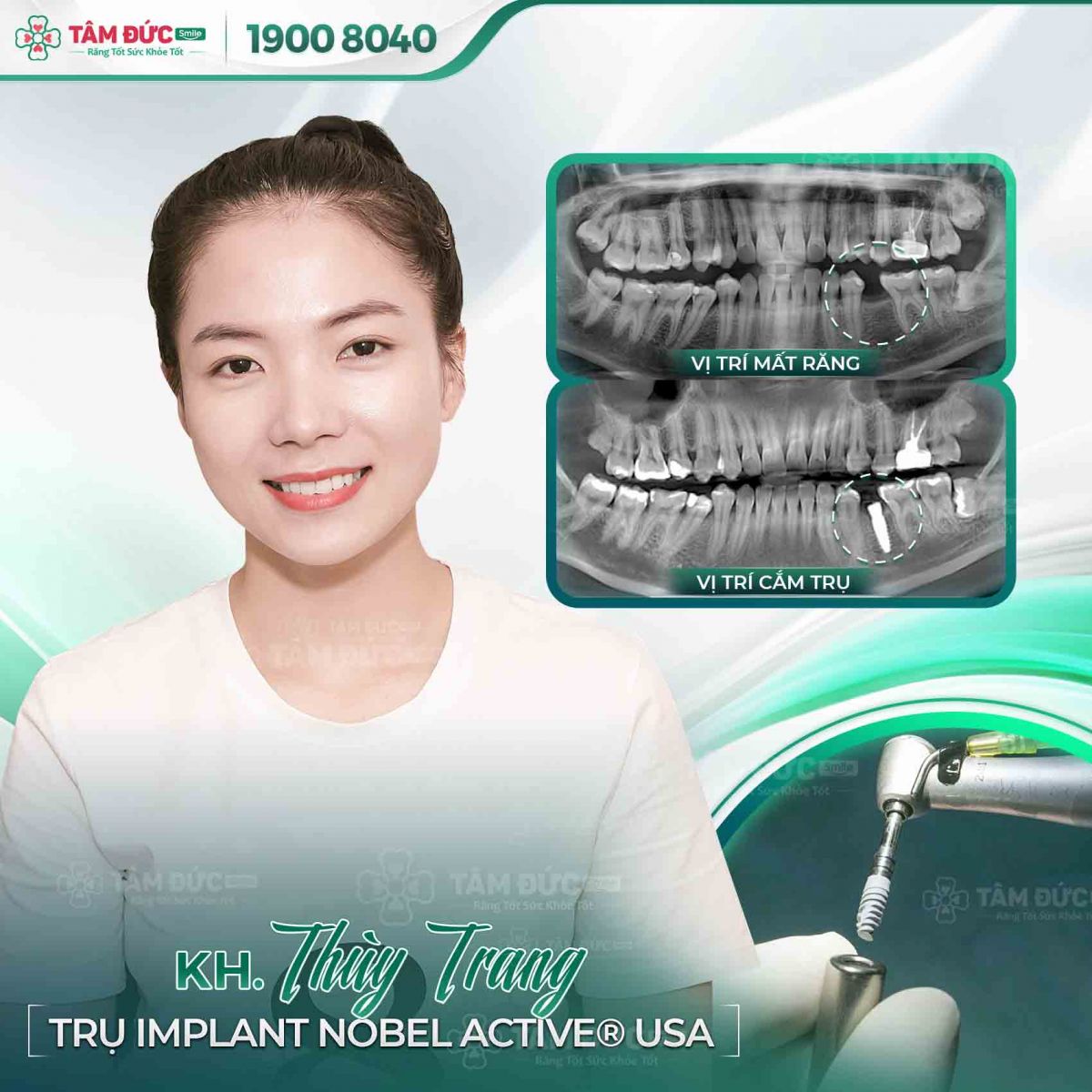 khách hàng trồng răng Implant tại nha khoa tâm đức smile