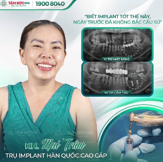 khách hàng trồng răng Implant tại nha khoa tâm đức smile