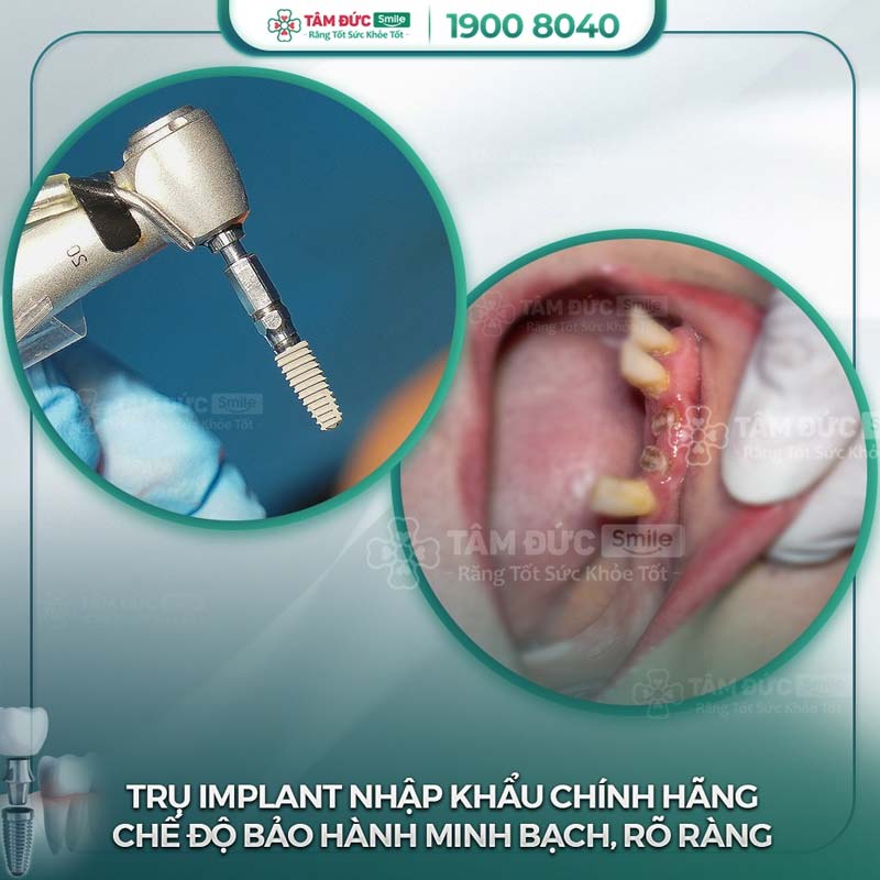 khách hàng trồng răng implant tại nha khoa Tâm Đức Smile sau khi nhổ bỏ răng chết tuỷ