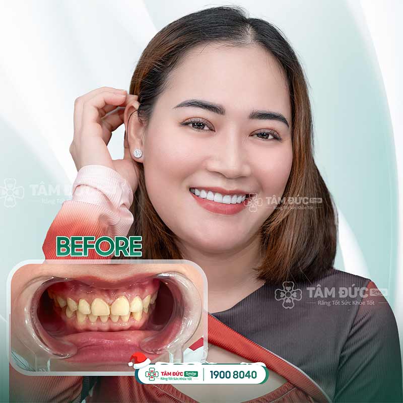 khách hàng bọc răng sứ khắc phục răng nhạy cảm tại nha khoa Tâm Đức Smile