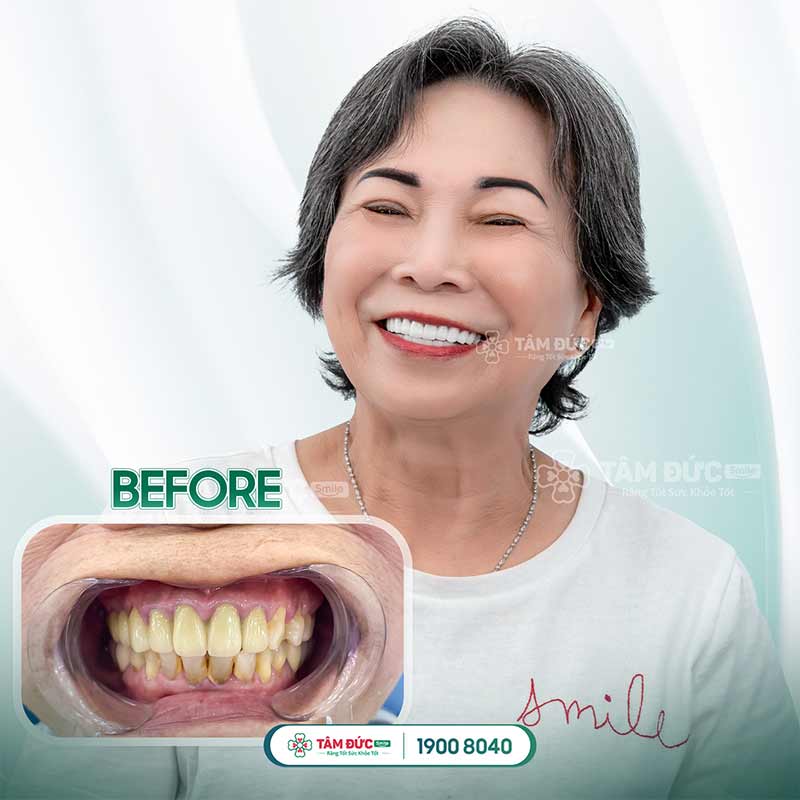 khách hàng bọc răng sứ khắc phục răng nhạy cảm tại nha khoa Tâm Đức Smile