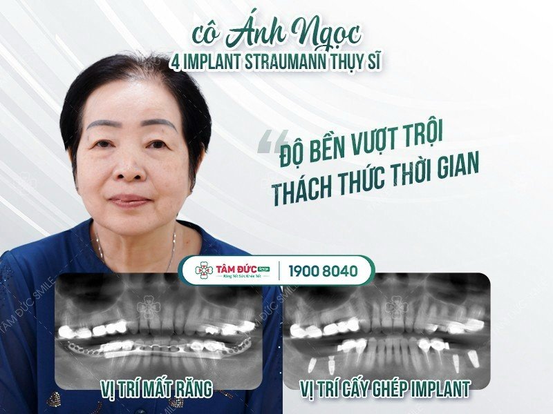 Giải pháp trồng răng giả vĩnh viễn