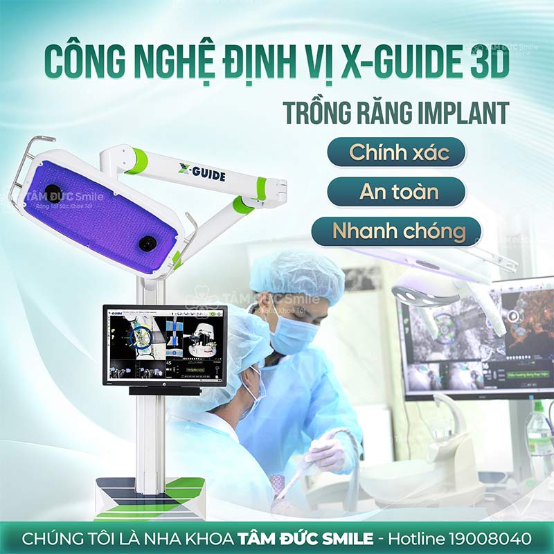 công nghệ định vị x-guide