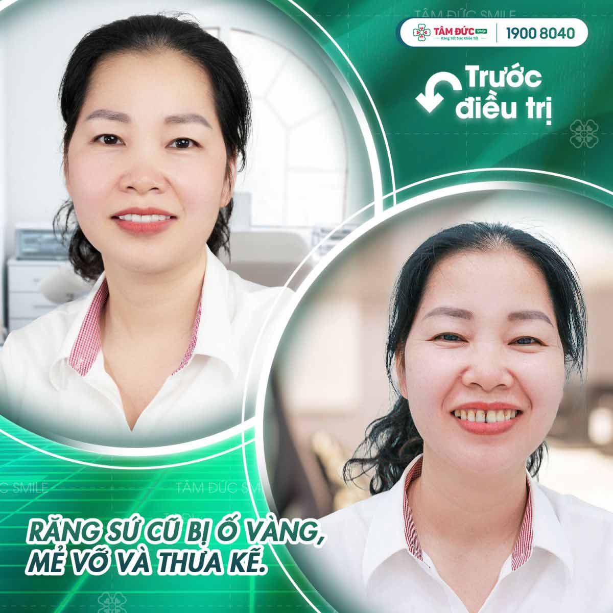 Chị Hiền sau khi bọc răng sứ tại Tâm Đức Smile