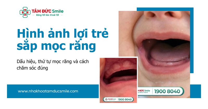 Hình ảnh lợi trẻ sắp mọc răng: Dấu hiệu, thứ tự mọc răng và cách chăm sóc đúng