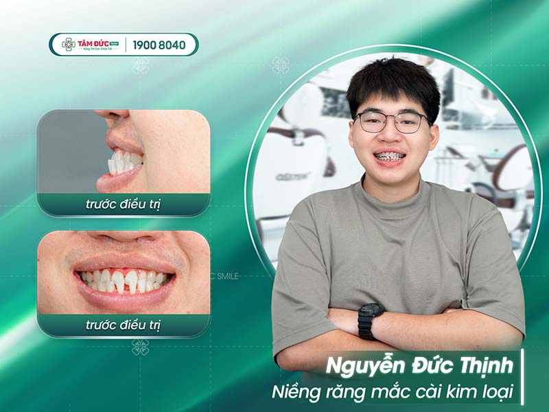 khách hàng niềng răng móm tại nha khoa Tâm Đức Smile