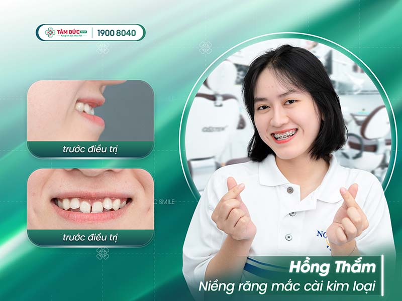 khách hàng niềng răng móm tại nha khoa Tâm Đức Smile