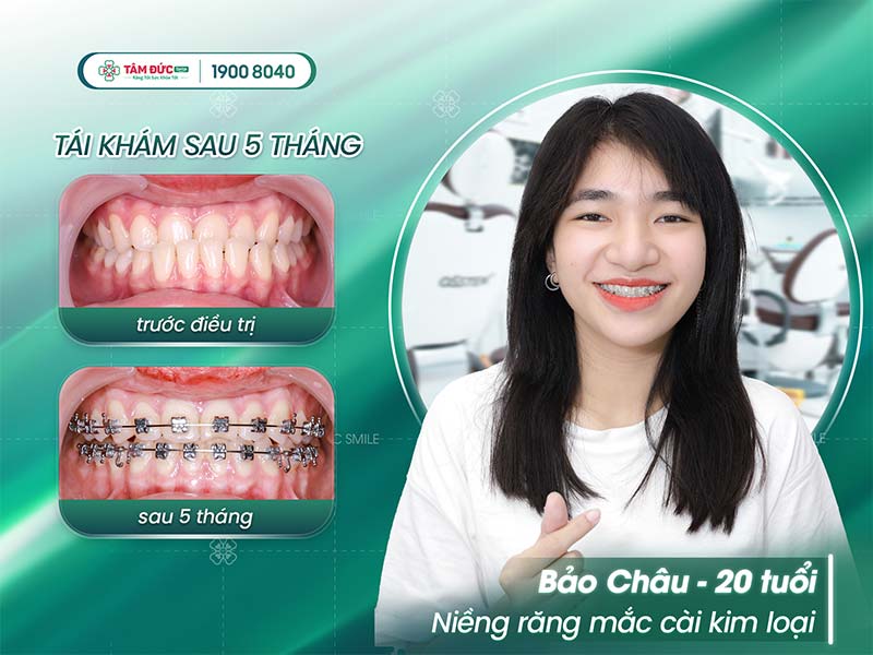 khách hàng niềng răng móm tại nha khoa Tâm Đức Smile