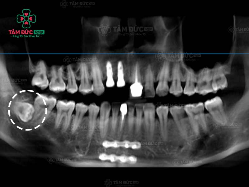 hình phim x-quang răng khôn mọc ngầm trong xương hàm