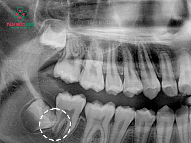 hình ảnh răng khôn mọc ngầm đâm vào răng số 7