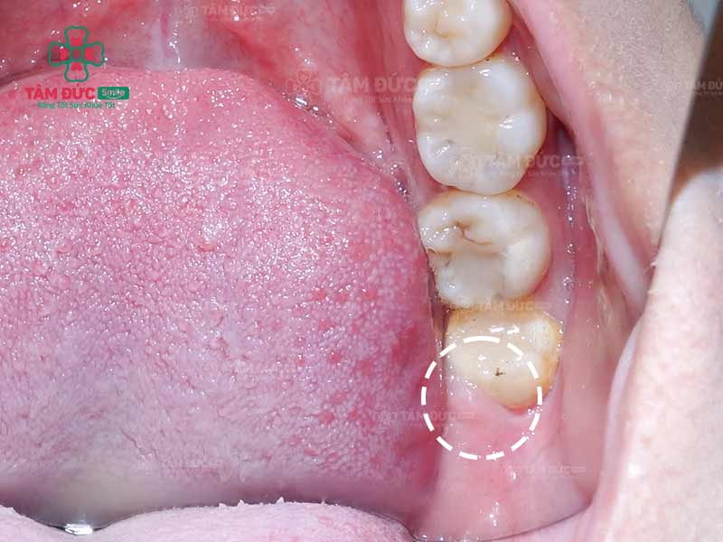 răng khôn mọc ngầm làm sưng nướu