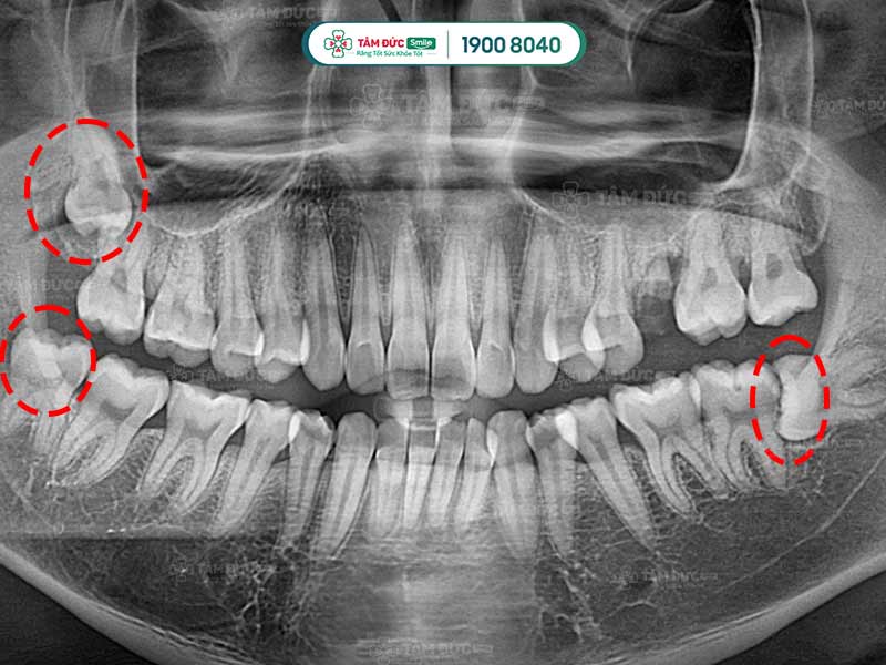 hình ảnh 3 chiếc răng khôn mọc ngầm qua phim chụp X-Quang