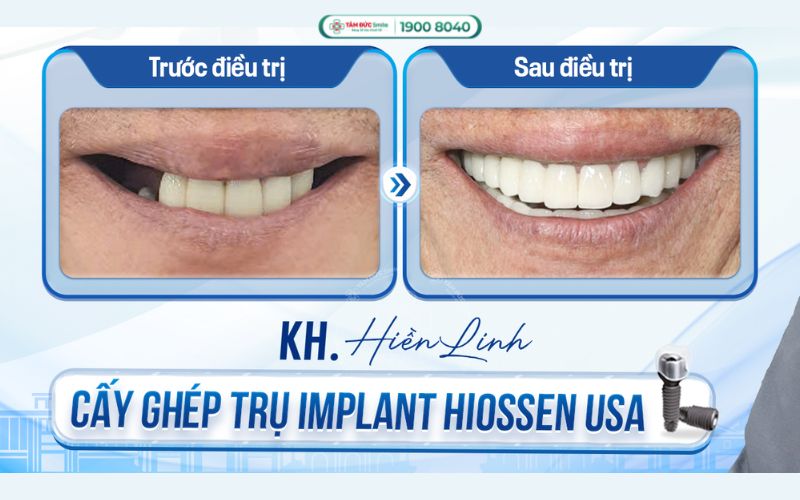trong-rang-implant-3