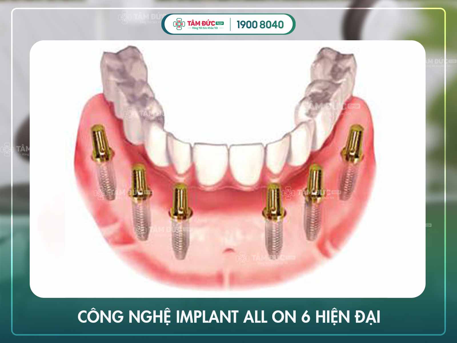 Implant All on 6 là gì