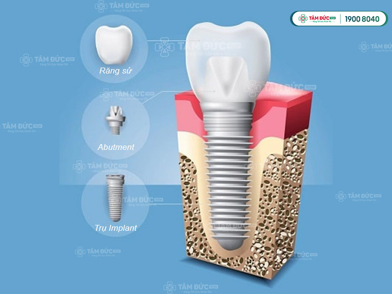 cấu tạo của trụ Implant