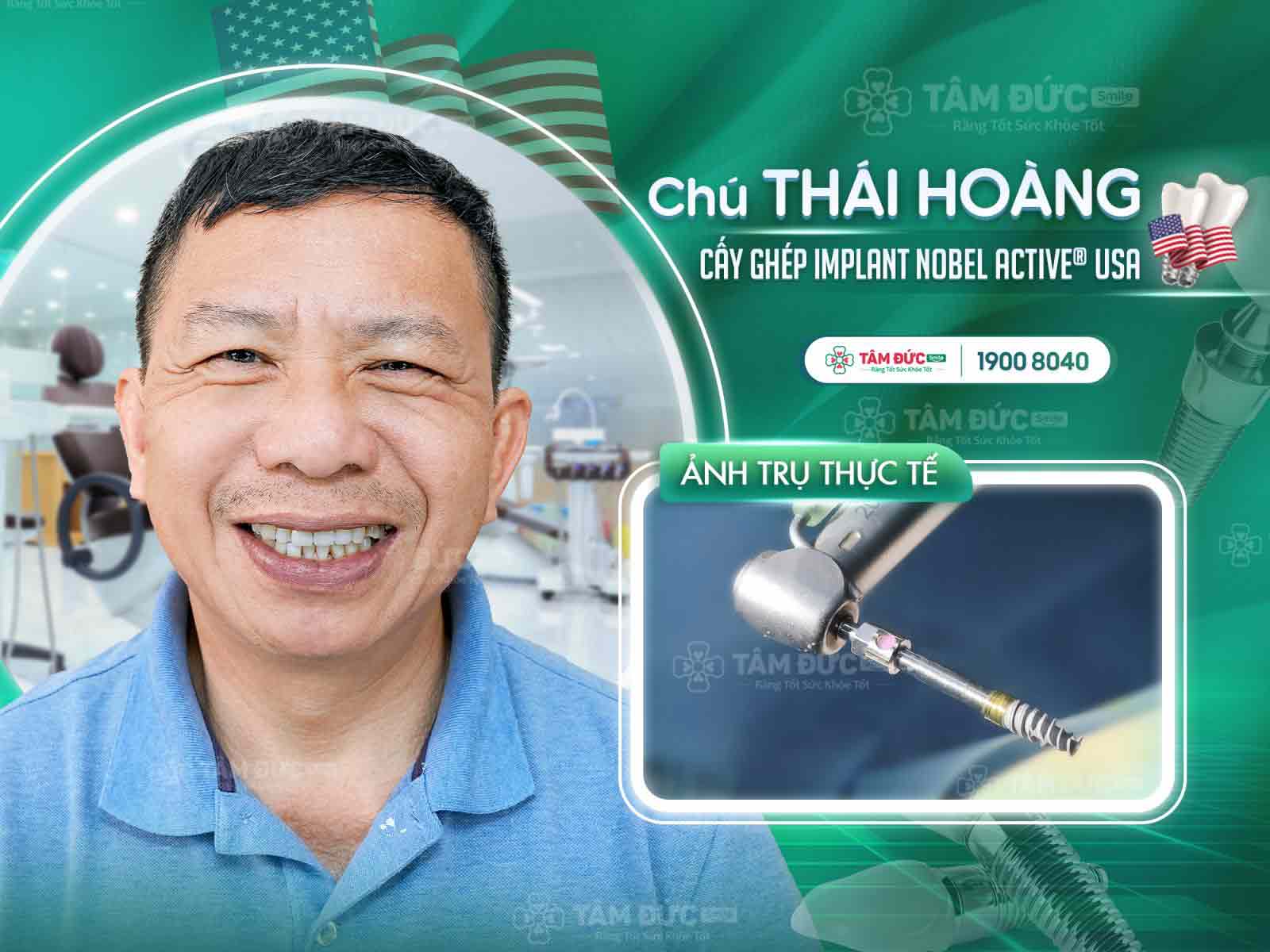 Implant Nobel Active Mỹ