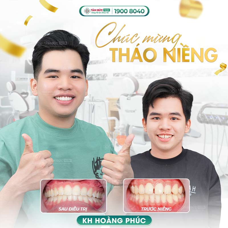 niềng răng chữa kẽ răng bị hở