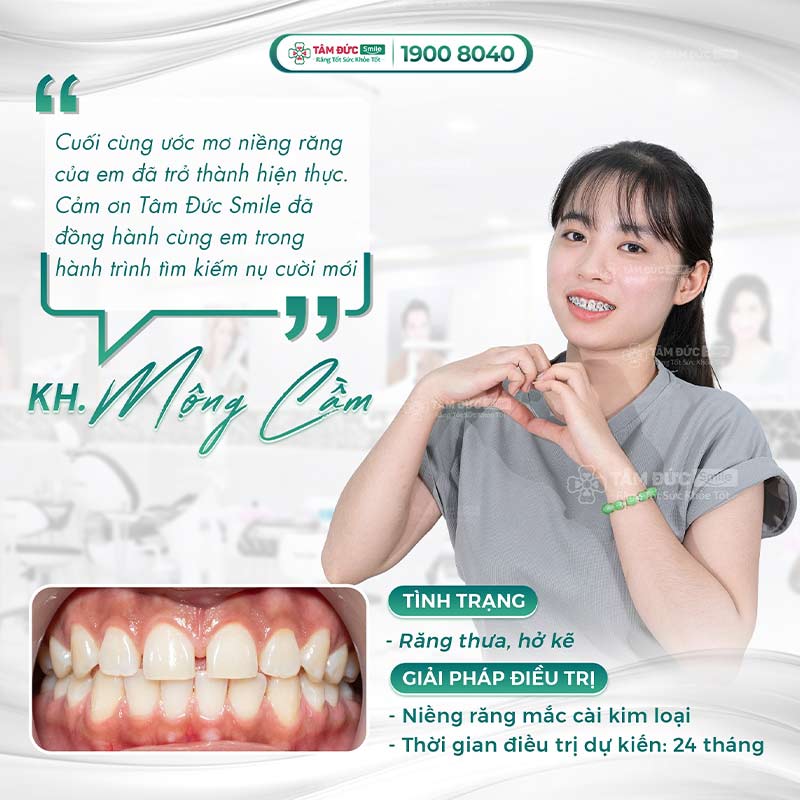 niềng răng chữa kẽ răng bị hở