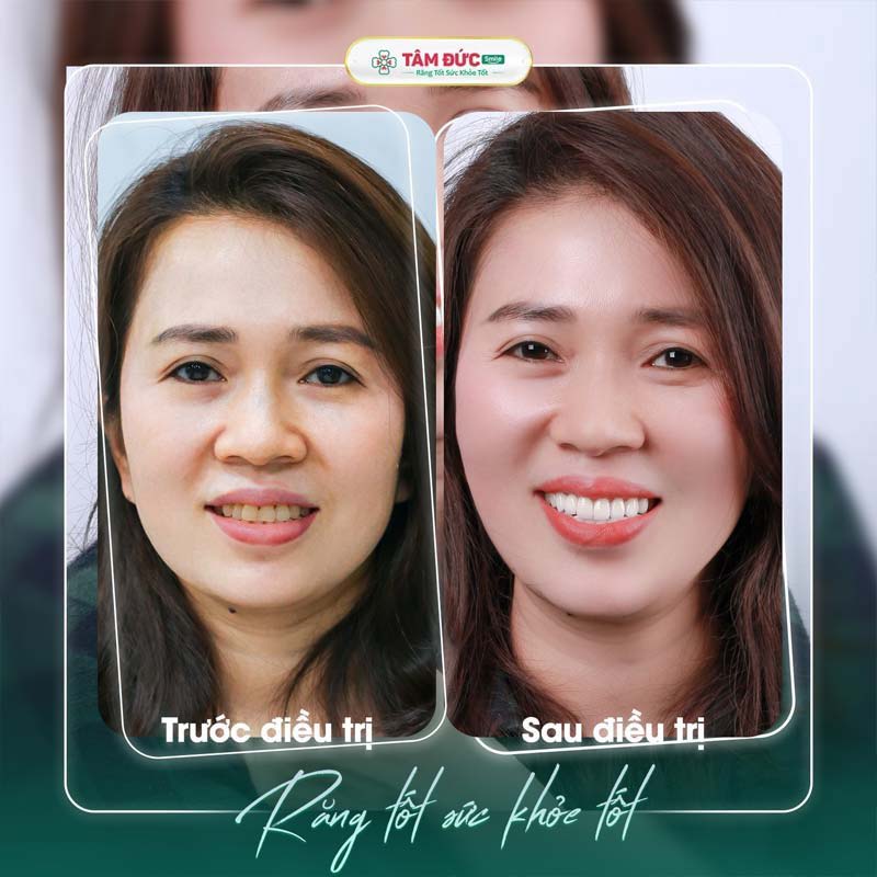 Bọc răng sứ tại Nha khoa Tâm Đức Smile khắc phục kẽ răng hàm bị đen