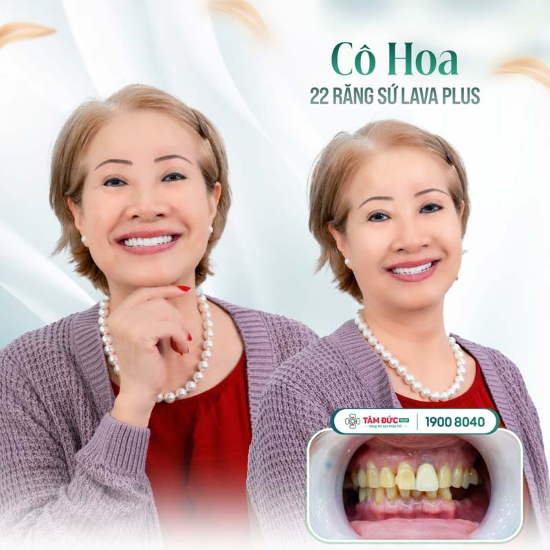 Bọc răng sứ tại Nha khoa Tâm Đức Smile khắc phục kẽ răng hàm bị đen