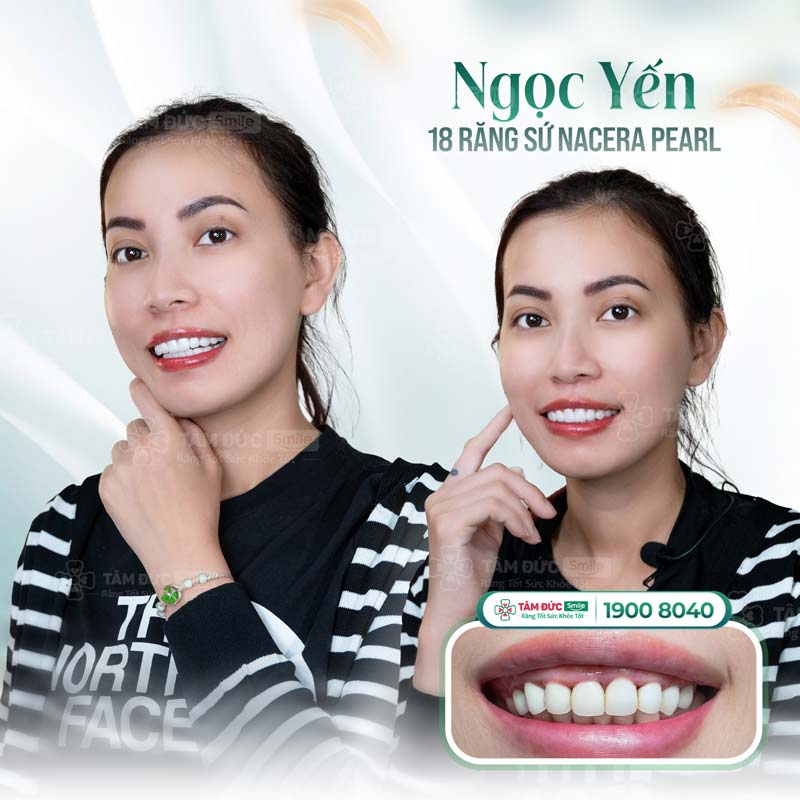 Bọc răng sứ tại Nha khoa Tâm Đức Smile khắc phục kẽ răng hàm bị đen