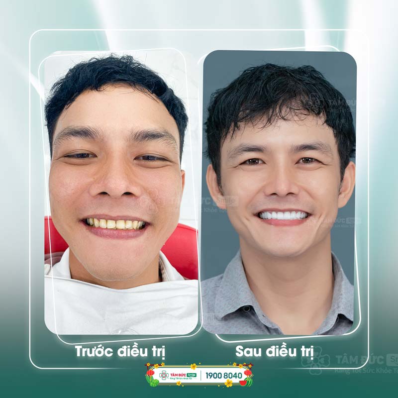 Bọc răng sứ tại Nha khoa Tâm Đức Smile khắc phục kẽ răng hàm bị đen